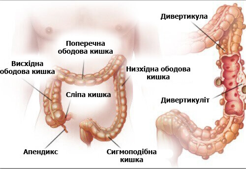 Дивертикуліт і дивертикульоз: діагноз та лікування