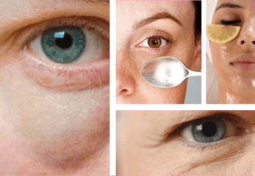 Прості поради від мішків під очима