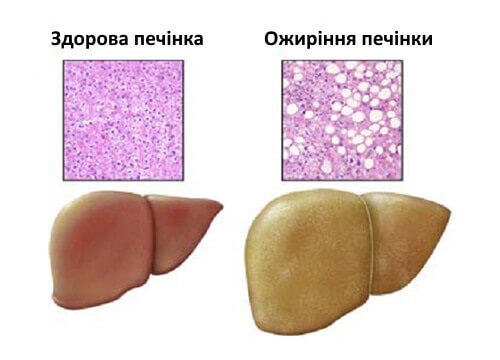 жирова хвороба печінки