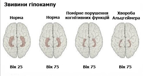 Навчіться розпізнавати ранні симптоми хвороби Альцгеймера