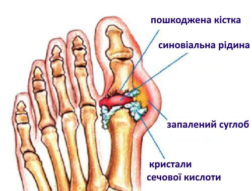 Натуральні засоби від подагри