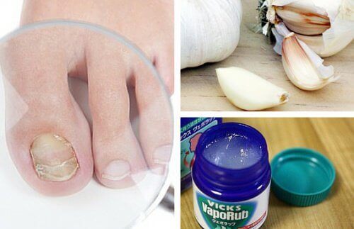﻿7 засобів від грибку нігтів