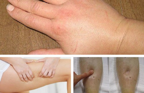 Затримка рідини: 5 природних сечогінних засобів