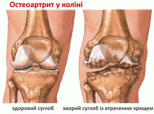 Біль у суглобах