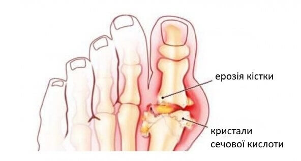 Симптоми сечової кислоти