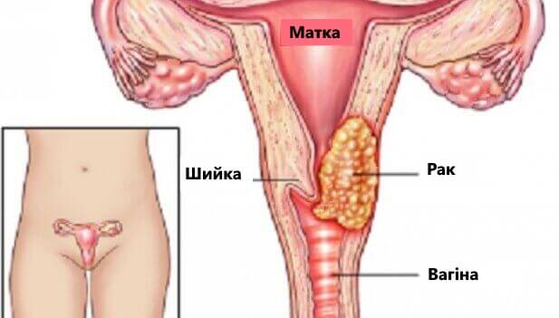 7 факторів, що можуть призвести до раку шийки матки
