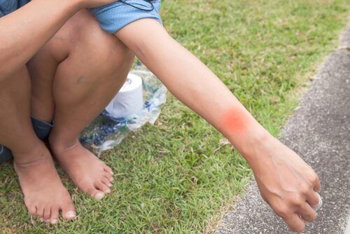 3-комар-укус