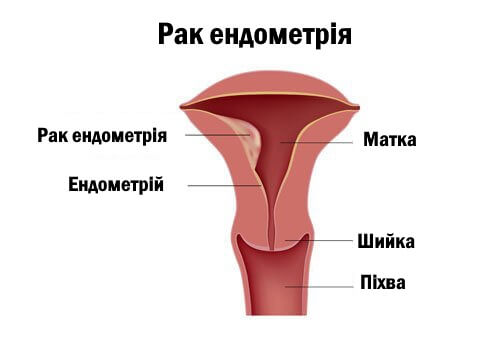 рак ендометрія