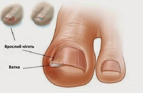 захворювання пальців ніг: врослі нігті