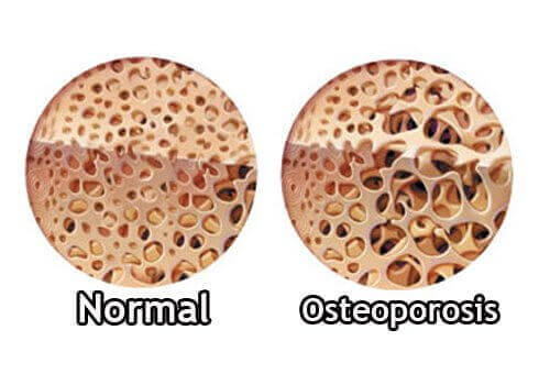 будова нормальної кістки та кістки з остеопорозом