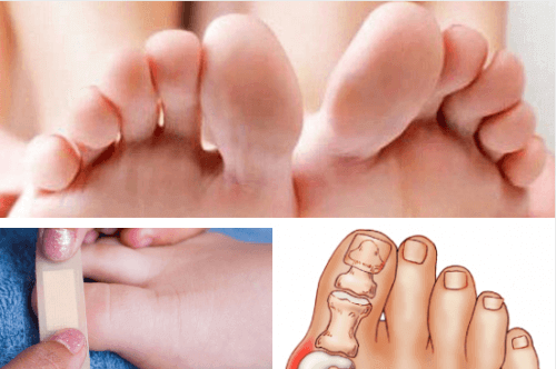 Травми та захворювання пальців ніг