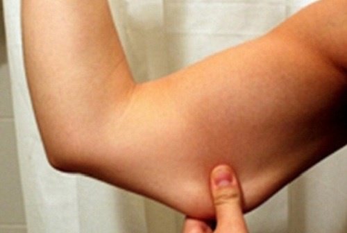 обвисла шкіра на руці