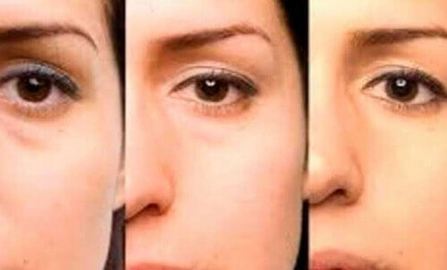 Як позбутися мішків під очима?