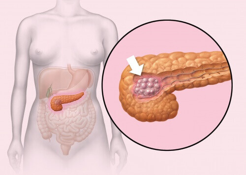 Показники захворюваності на рак підшлункової залози збільшуються