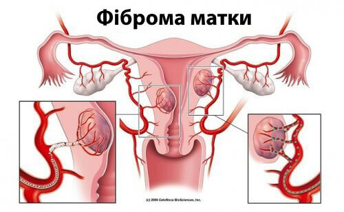 Фіброма матки: 5 фактів, які варто знати