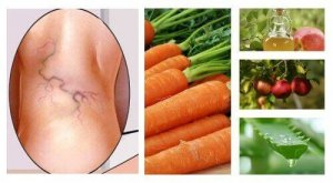 Натуральний засіб він варикозу вен