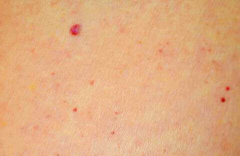 чи небезпечні червоні цятки на шкірі