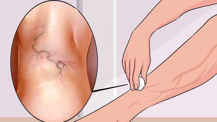 варикозне розширення вен нижніх кінцівок