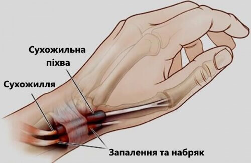 Теносіновіт: запалення зап'ясть і суглобів ніг