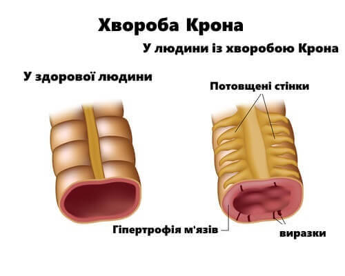 Лікування хвороби Крона за допомогою правильної дієти