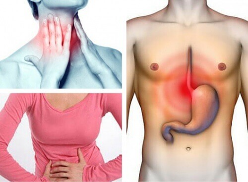 Ви страждаєте на шлунковий рефлюкс?