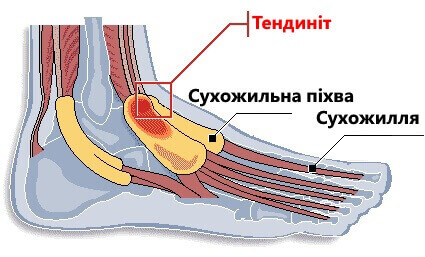 теносиновіт на стопі