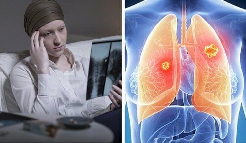 Рак легенів є набагато більш загрозливим для жінок