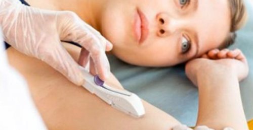 протизаплідні імплантати для жінок