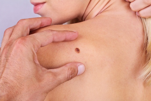 7 фактів, яких ви не знали про рак шкіри