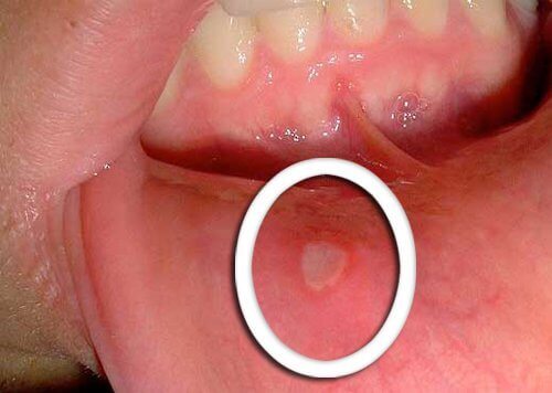 виразки як симптом ротоглоткового раку