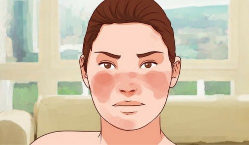 7 засобів для контролю над вовчаком