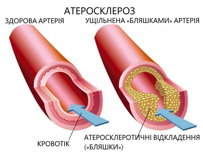 Атеросклероз