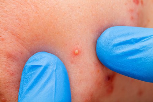 акне на шрікі