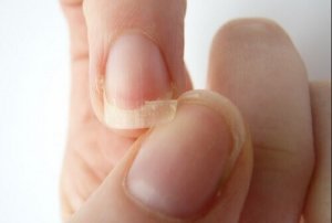 Дізнайтеся 9 причин ламкості нігтів