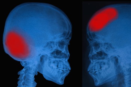 симптоми інсульту череп