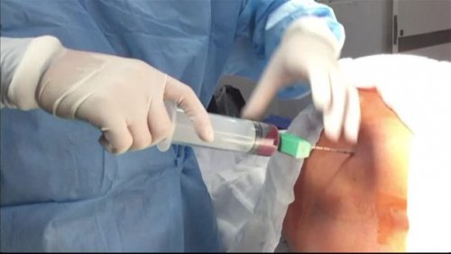 донор кісткового мозку