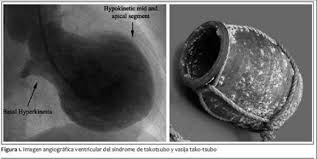 синдром розбитого серця та його наслідки