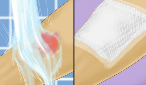 Перша допомога при опіках окропом