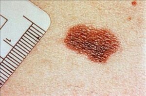 Ознаки раку шкіри, які не варто ігнорувати