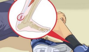 Тендиніт ахіллового сухожилля: 5 способів захисту