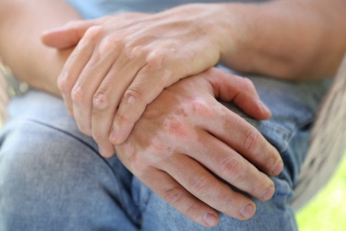 9 природних засобів від хвороби вітіліго