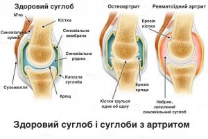 Чим відрізняються артрит, остеоартрит та остеопороз