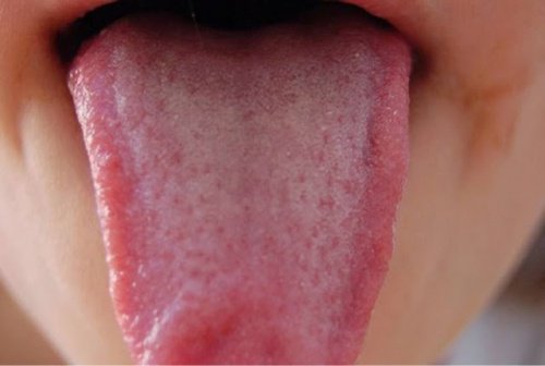 стан язика, а саме полунично-червоний колір, свідчить про дефіцит вітаміну В12