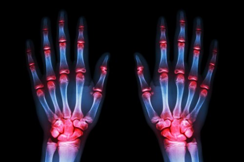 остеоартроз