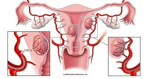 Міома матки: 7 перших симптомів