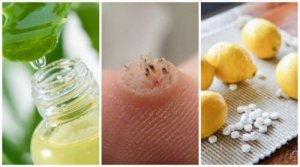 6 потужних засобів, щоб позбутися бородавок