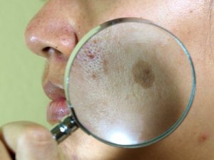 7 натуральних засобів від пігментних плям