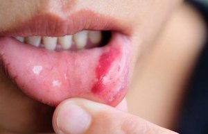 Рак порожнини рота: симптоми та методи запобігання