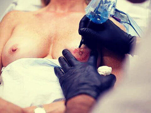 татуювання після мастектомії