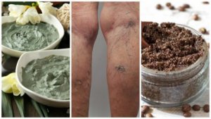 Як позбутися варикозного розширення вен домашніми засобами